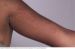 اثر کشیدگی پوست روی دست