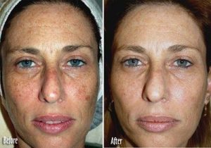 استفاده از آی پی ال برای رفع چین و چروک