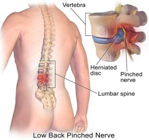 طب سوزنی درد سیاتیک را تسکین می دهد