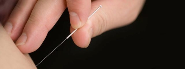 سوزن طب سوزنی بر روی پوست و تاریخ طب سوزنی
