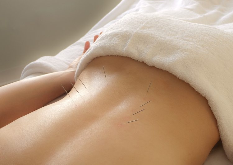 طب سوزنی برای سیاتیک