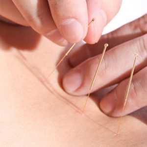 طب سوزنی برای کاهش وزن