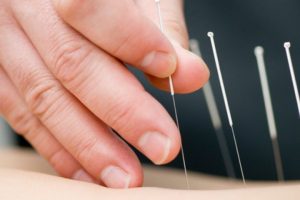 طب سوزنی برای درمان سلولیت