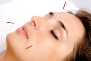 طب سوزنی برای درمان آکنه
