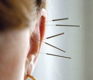 طب سوزنی گوش یکی از روش های کاهش وزن