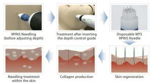 تولید کلاژن با استفاده از سوزن کاری پوست