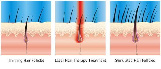 افزایش رشد مو لیزر موهای زائد