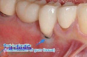 بافت عفونی اطراف ایمپلنت دندانی پری-ایمپلنتایتیس