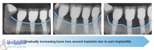 تحلیل رفتن استخوان به علت پری-ایمپلنتایتیس