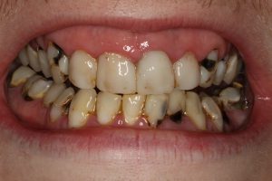 خراب شدن و پوسیدگی دندان ها