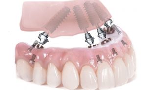 روش 4 ایمپلنت دندان مصنوعی