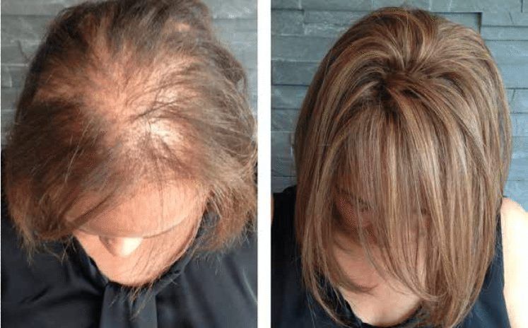 درمان ریزش مو و کاهش شدید کم شدن موها