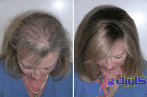 hair-loss-solutions