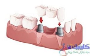 بریج دندانی ثابت