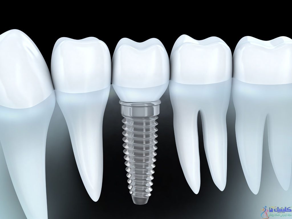 مزایای ایمپلنت دندانی