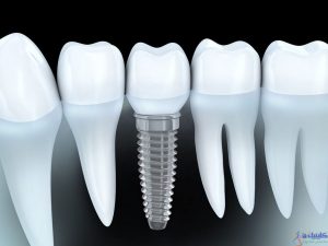 مزایای ایمپلنت دندانی