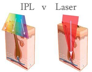 تفاوت لیزر دیود با آی پی ال