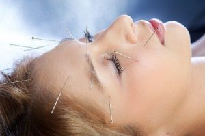 درمان افتادگی پوست صورت با طب سوزنی همچنین باعث کاهش استرس می شود