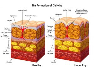 سولیت به دلیل توزیع نا متوازن سلول های چربی در زیر پوست به وجود می آید