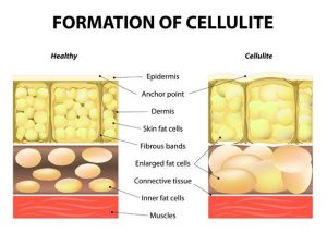 جلوگیری از ایجاد سلولیت یا چربی زیر پوستی