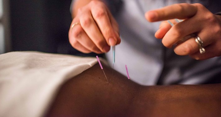 طب سوزنی چیست و چرا استفاده از آن برای بیماری ها پیشنهاد می شود؟