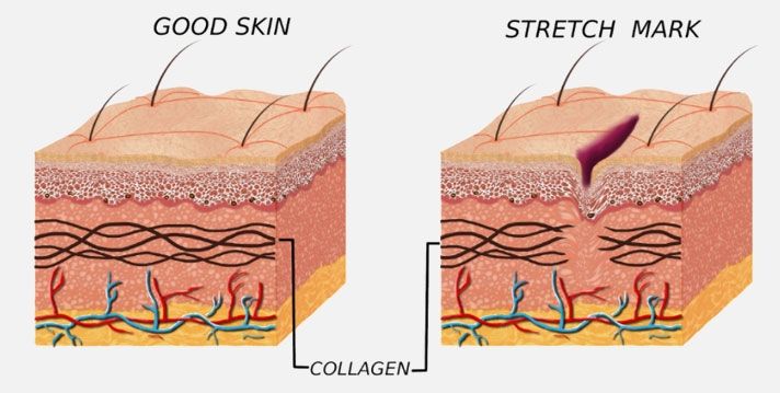استرچ مارک و ترک پوستی