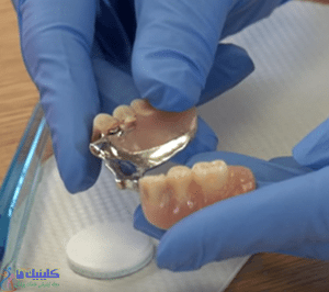 تمیز کردن دندان مصنوعی جزئی