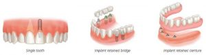 روش های مختلف ایمپلن دندان مصنوعی بریج