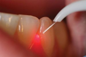 لیزر درمانی دندان ها درمان بوي بد دهان