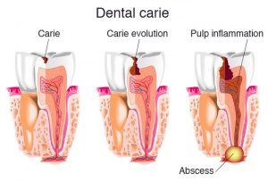 مراحل خراب شدن دندان و عفونت و آبسه