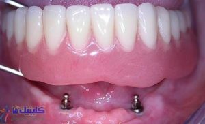 مینی ایمپلنت برای دندان مصنوعی