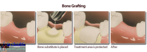 پیوند استخوان فک پیش از جراحی ایمپلنت پیشرفته دندان