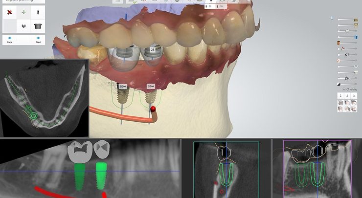 جراحی ایمپلنت دندان چطور انجام می‌شود؟