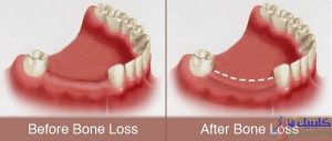 تحلیل رفتن بافت استخوانی در محل افتادن دندان