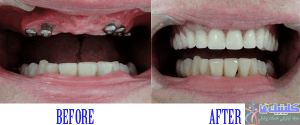 اولین مرحله جایگزین دندان با ایمپلنت