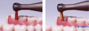 کشیدن دندان به روش آتروماتیک