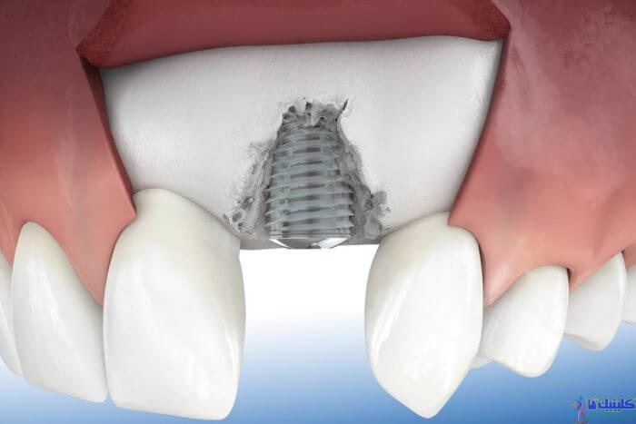 پیوند استخوان فک برای ایمپلنت دندانی