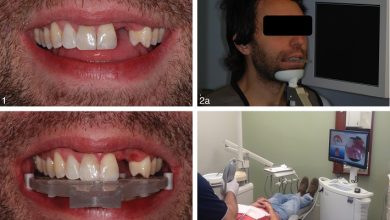 روش ایمپلنت دندان فوری با روش پانچ و دیجیتال چه مزایا و مشکلاتی دارد؟