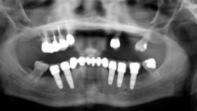 عوارض ایمپلنت دندان چیست و این روش چه مشکلات و خطراتی می‌تواند داشته باشد؟