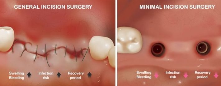 ایمپلنت دندان بدون جراحی با روش فلب لس پانچ