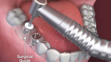 ايمپلنت دندان بدون جراحی بهترین جایگزین یک یا چند دندان کشیده