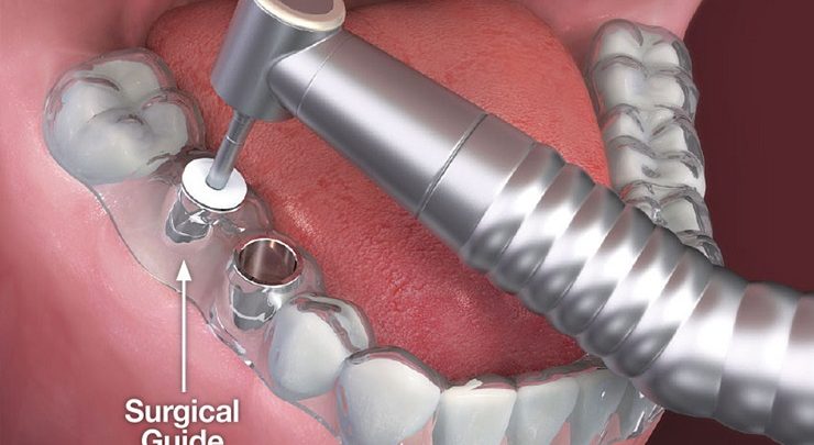 ايمپلنت دندان بدون جراحی بهترین جایگزین یک یا چند دندان کشیده