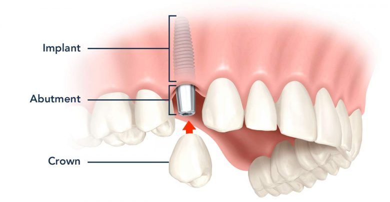 کاشت دندان ایمپلنت با روش پانچ بدون جراحی