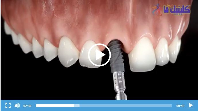 فیلم کاشت ایمپلنت بعد از کشیدن دندان
