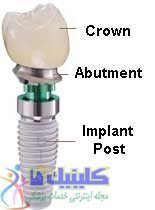 رابط ایمپلنت برای کاشت دندان