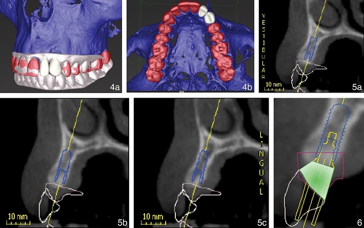 مراحل دیجیتال قرار دادن دندان ایمپلنتی