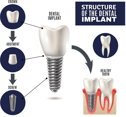 ساختار ایمپلنت دندان