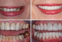 جایگزین دندان با ایمپلنت