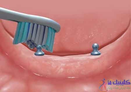 عوارض ایمپلنت دندان چیست؟