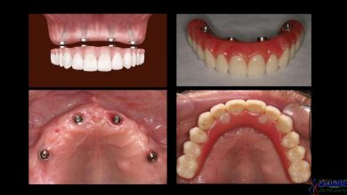 درمان لقی دندان مصنوعی با روش 4 ایمپلنت